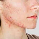Anti-Lice Treatment